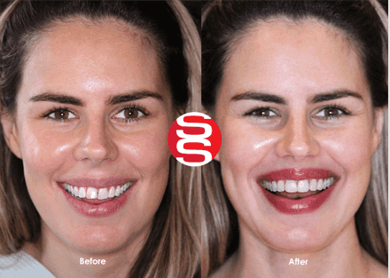 Porcelain Veneers